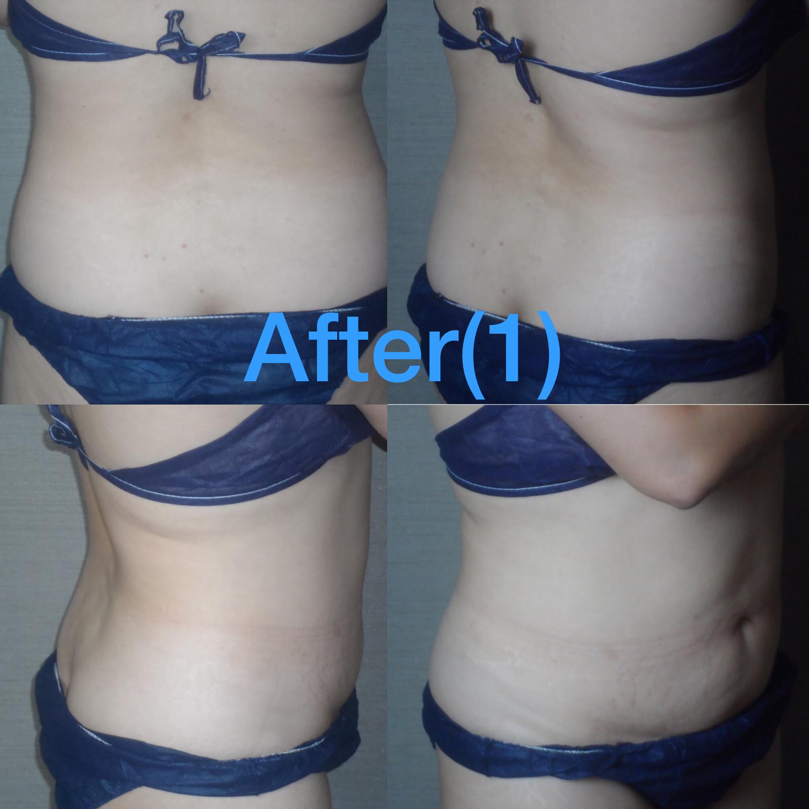 Post fat-freezing treatment.